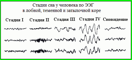 Стадии сна по электроэнцефалограмме (ЭЭГ)